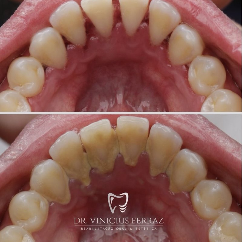 Antes e depois de limpeza dental