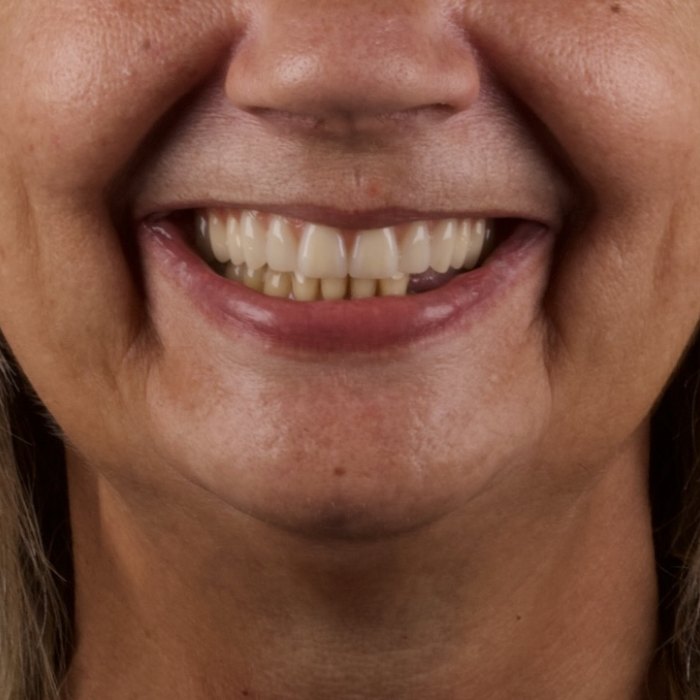 Sorriso com prótese dentária
