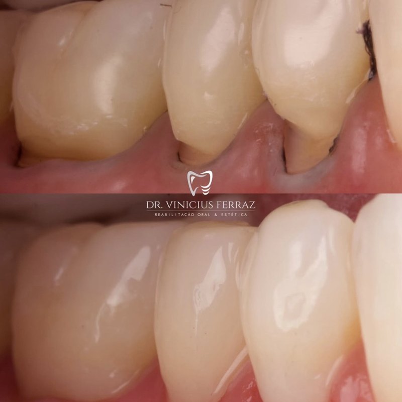 Antes e depois de restauração dentária